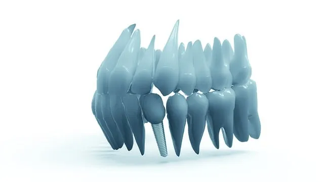 dental implants mcallen tx