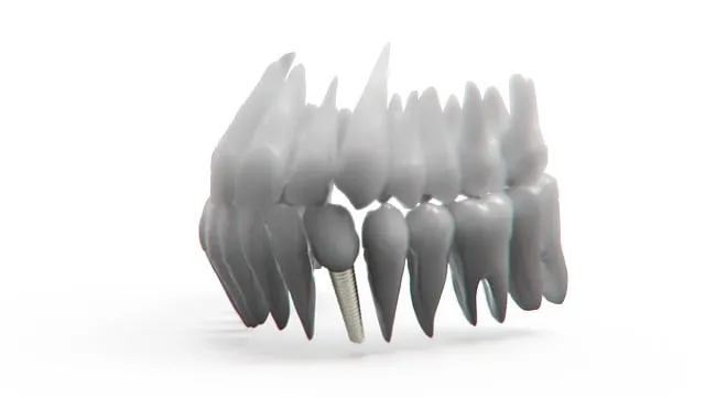 dental implants mcallen tx