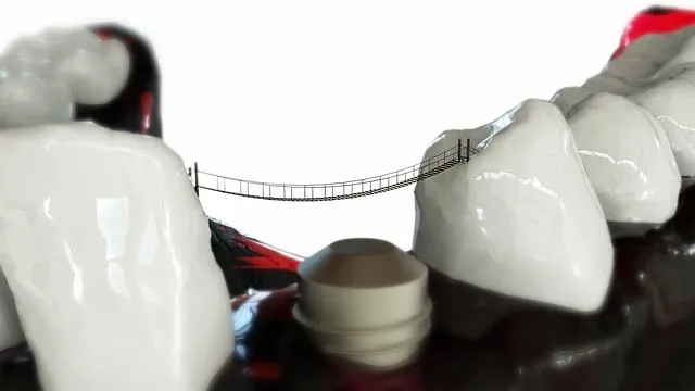 how-do-i-prepare-for-a-dental-implant-pr-640x480-73322311.jpeg