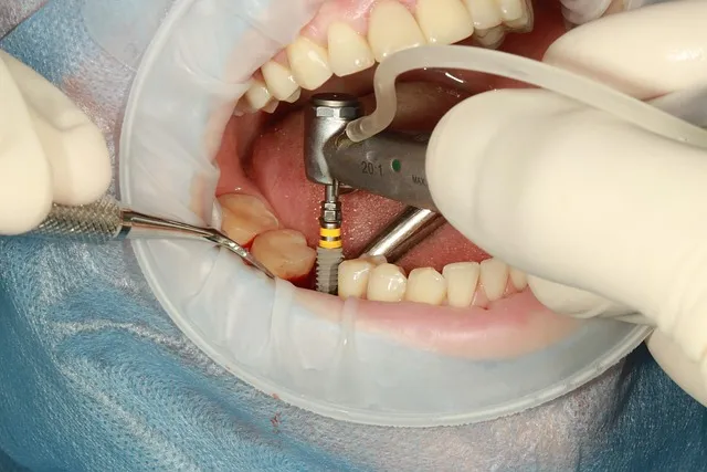dental implants mcallen tx