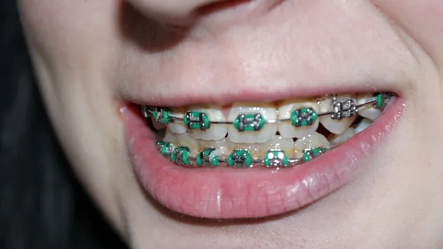 mcallen-tx-braces-640x480-11327361.jpeg
